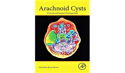 Arachnoid Cysts